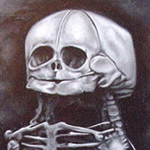 Painting of Conjoined Twins