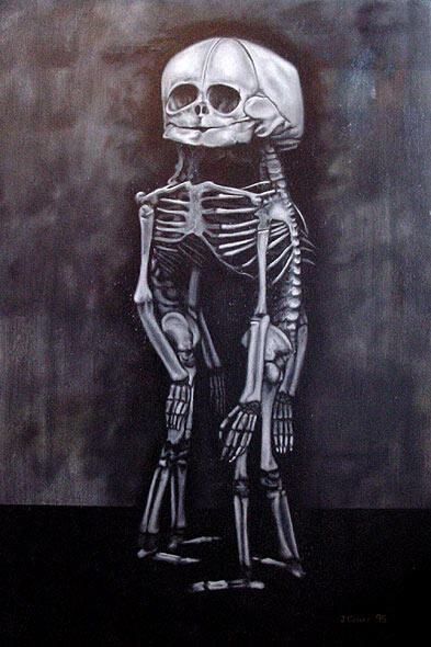 Painting of Conjoined Twins